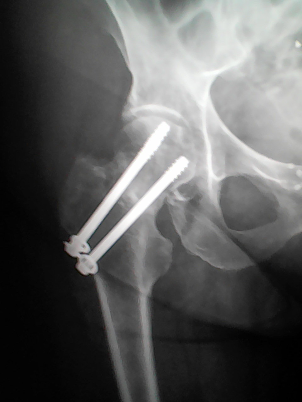 BROKEN: X-ray of Joan’s femur